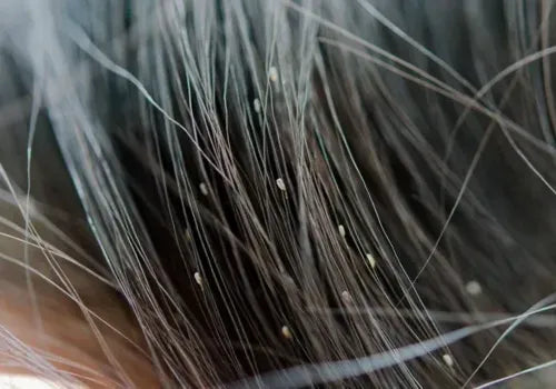 Small, moving lice or white, oval-shaped eggs (nits) attached to hair shafts.