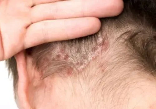 Scratching can lead to red, inflamed patches on the scalp.