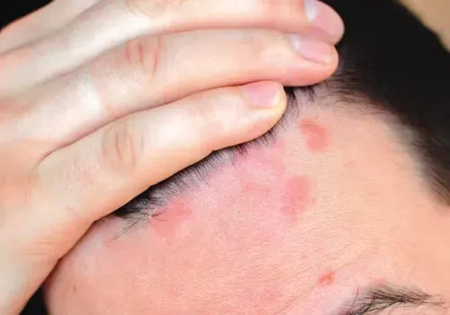 A sensation of something moving or crawling in the hair.